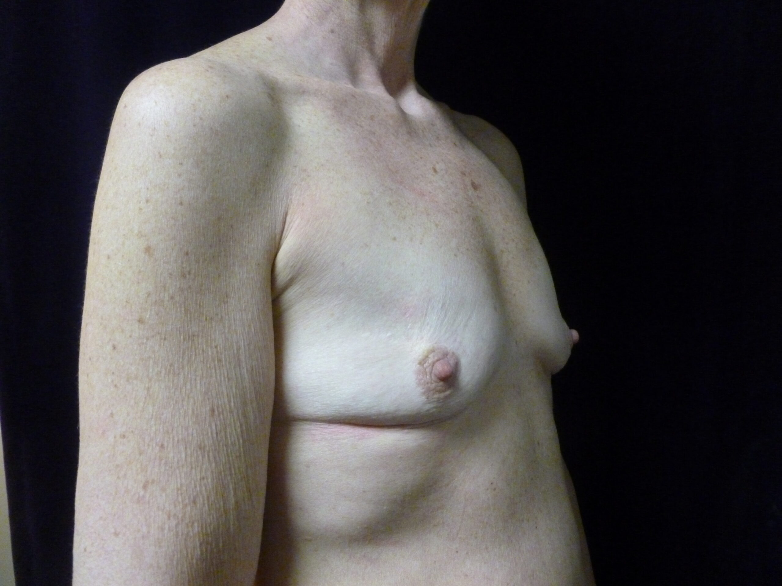 Breast Augmentation Patient Photo - Case 2309 - before view-1