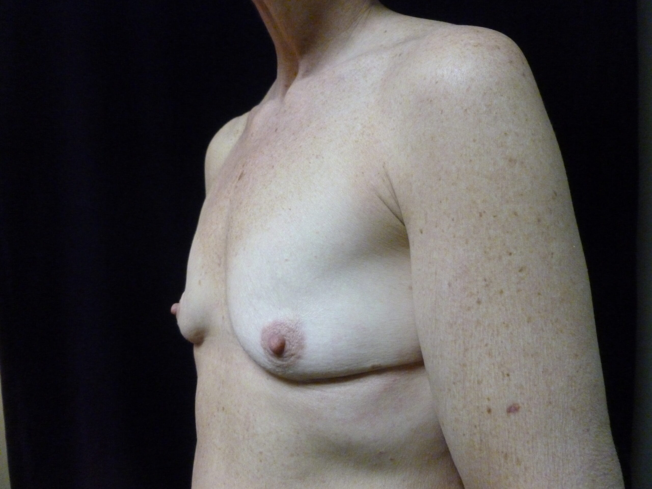 Breast Augmentation Patient Photo - Case 2309 - before view-2