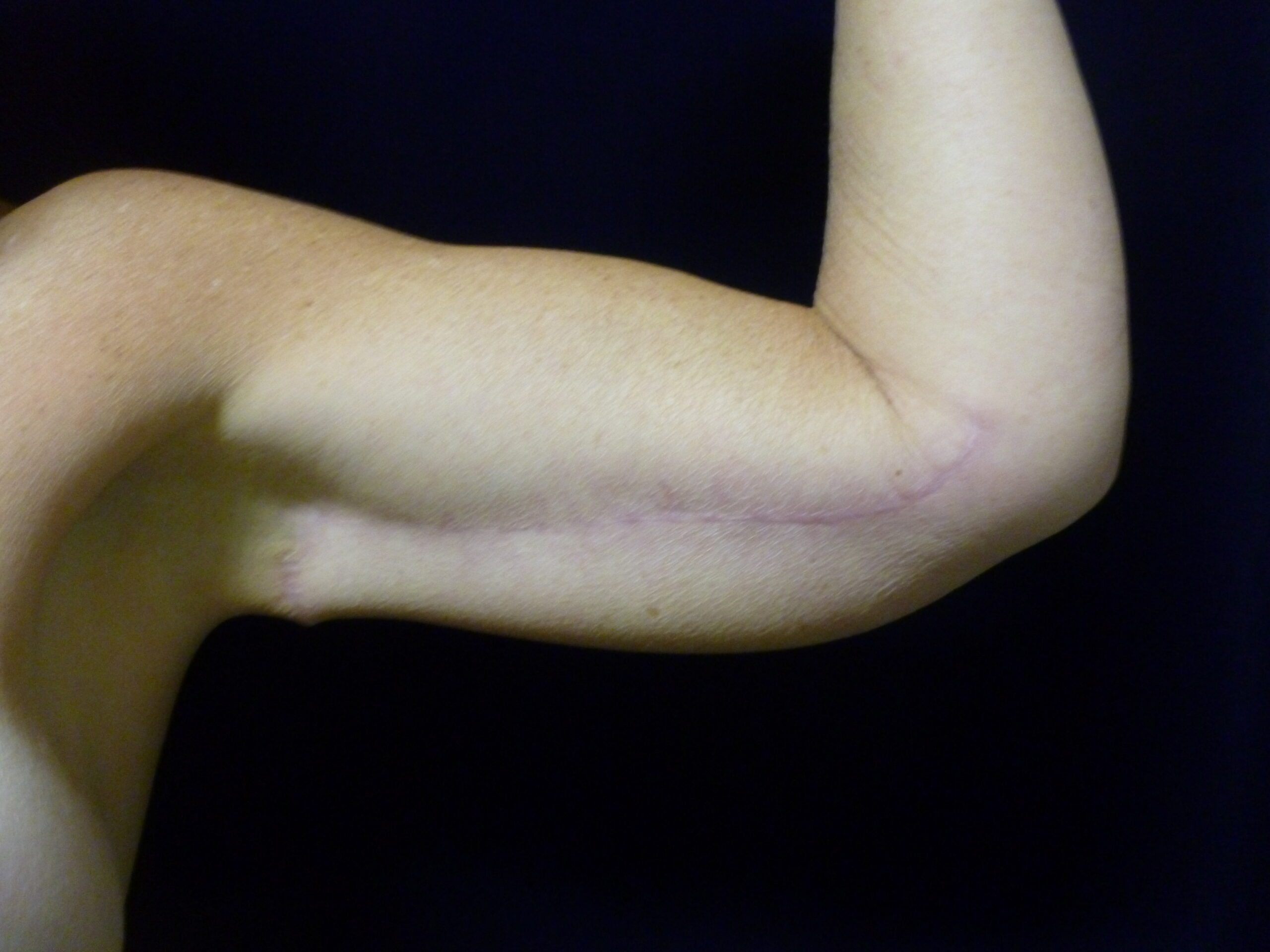 Arm Lift Patient Photo - Case 2294 - after view-1