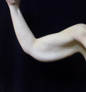 Arm Lift - Case 2294 - Before