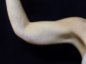 Arm Lift - Case 2294 - After