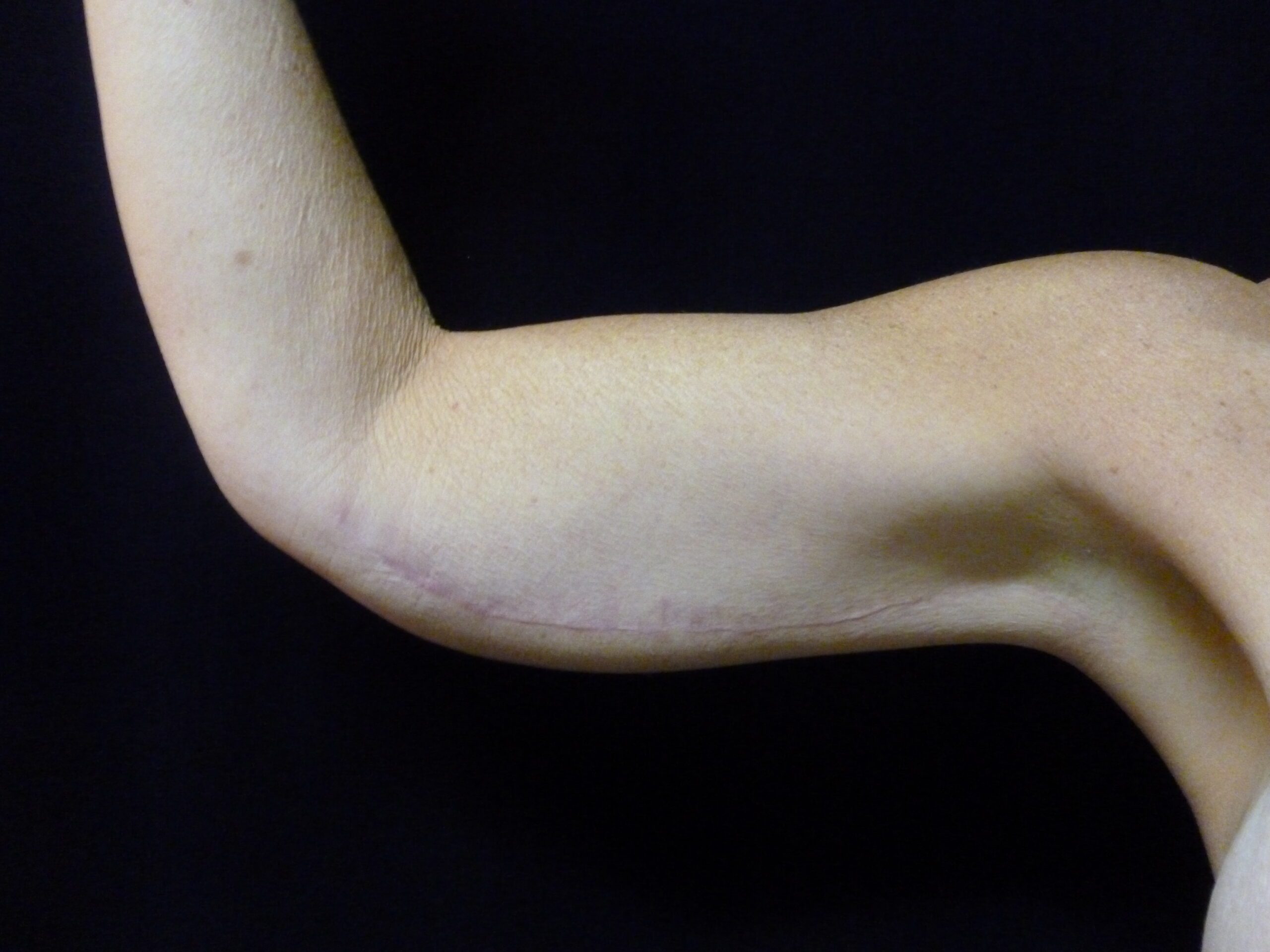 Arm Lift Patient Photo - Case 2294 - after view