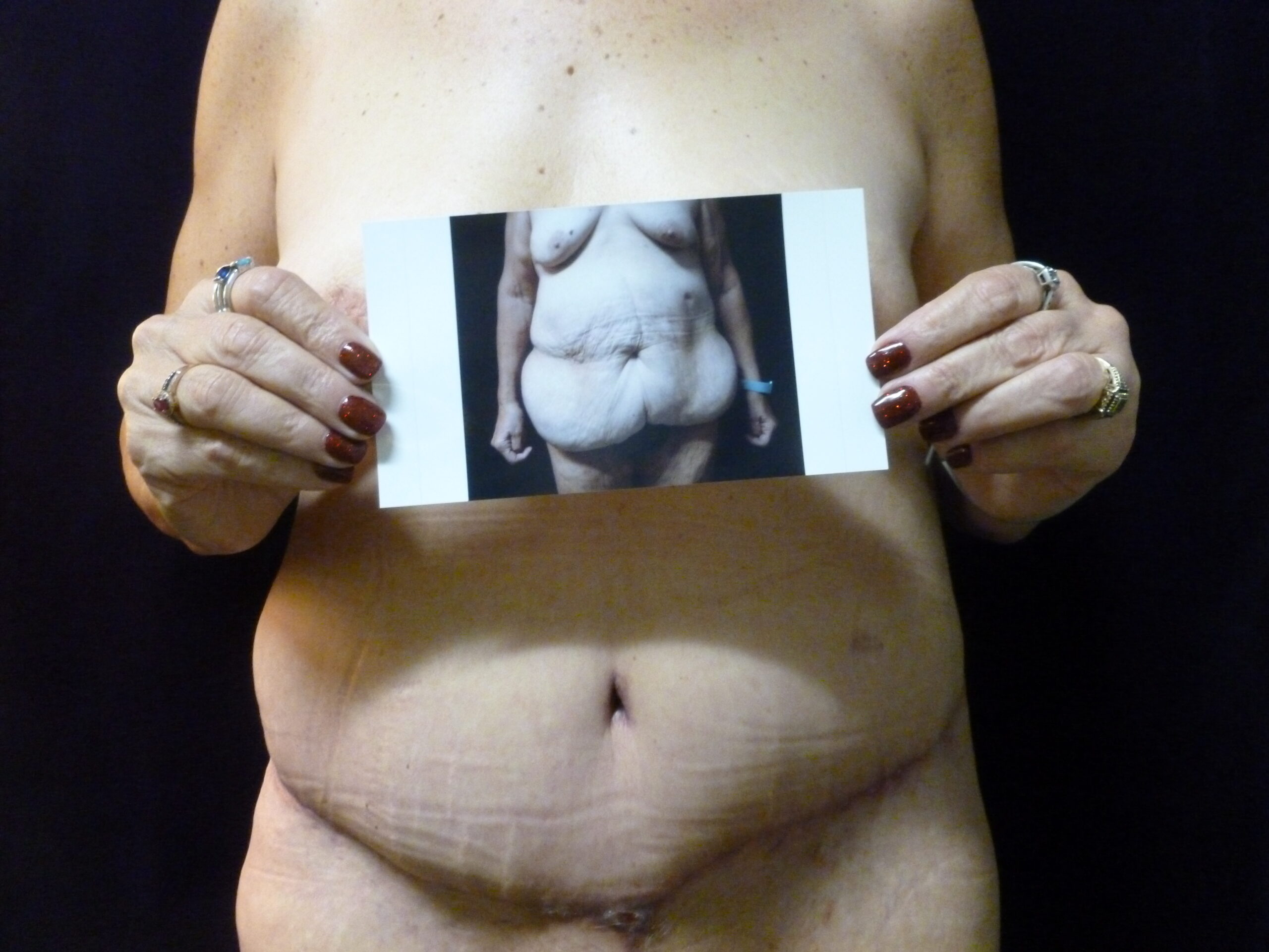 Tummy Tuck Patient Photo - Case 2310 - before view-3