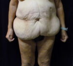 Tummy Tuck - Case 2310 - Before