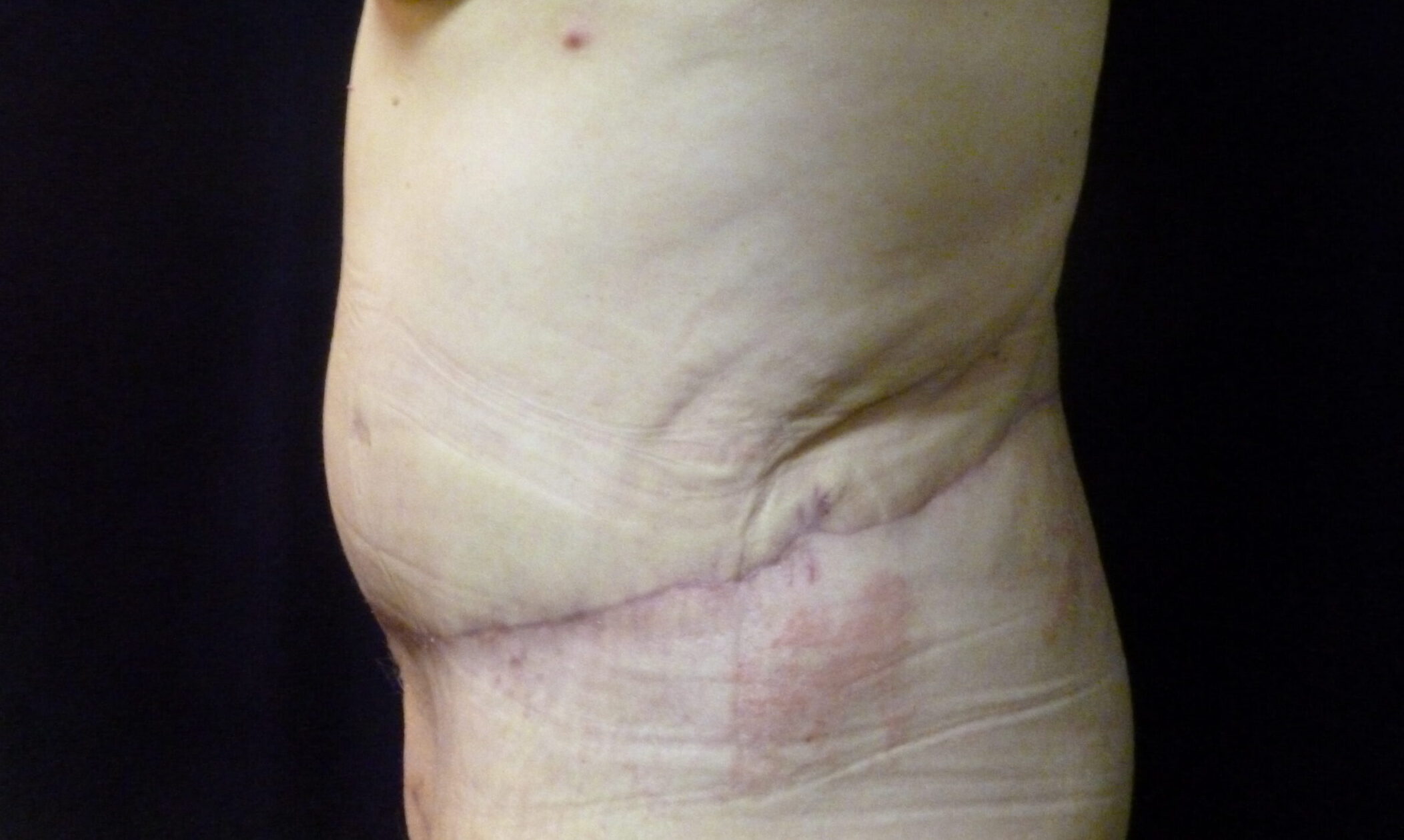 Tummy Tuck Patient Photo - Case 2310 - after view-1