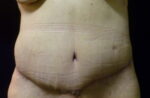 Tummy Tuck - Case 2310 - After