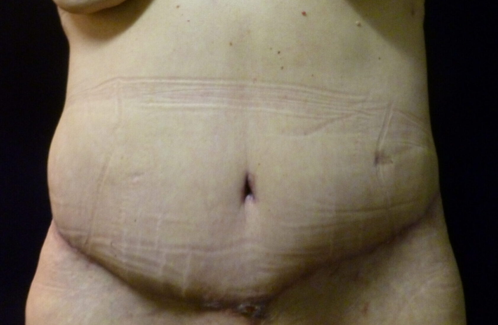 Tummy Tuck Patient Photo - Case 2310 - after view