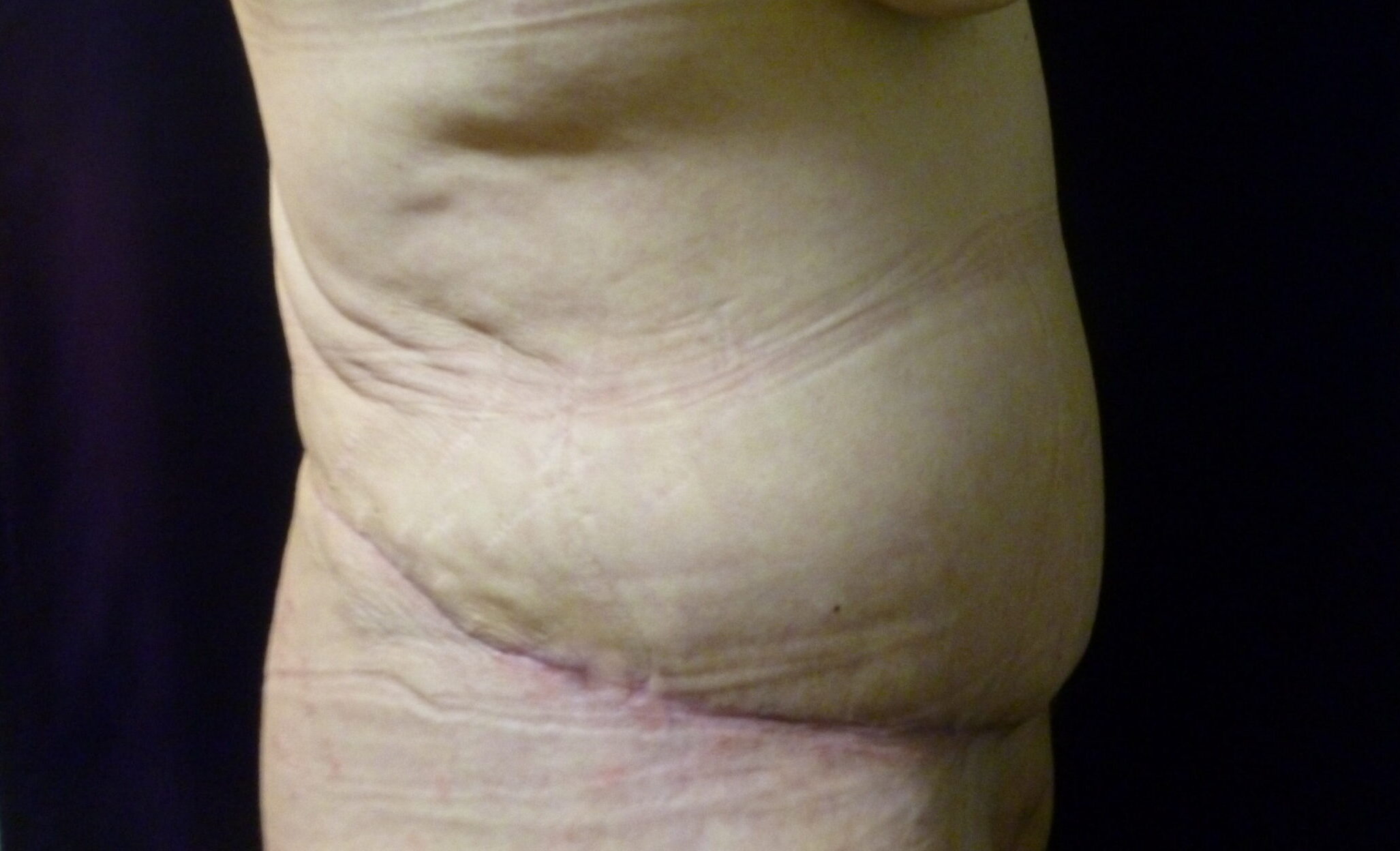 Tummy Tuck Patient Photo - Case 2310 - after view-2