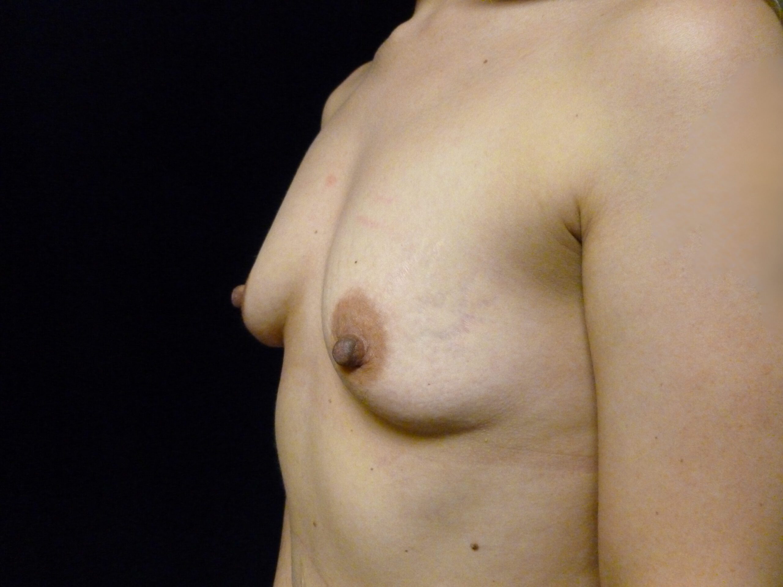Breast Augmentation Patient Photo - Case 2320 - before view-1