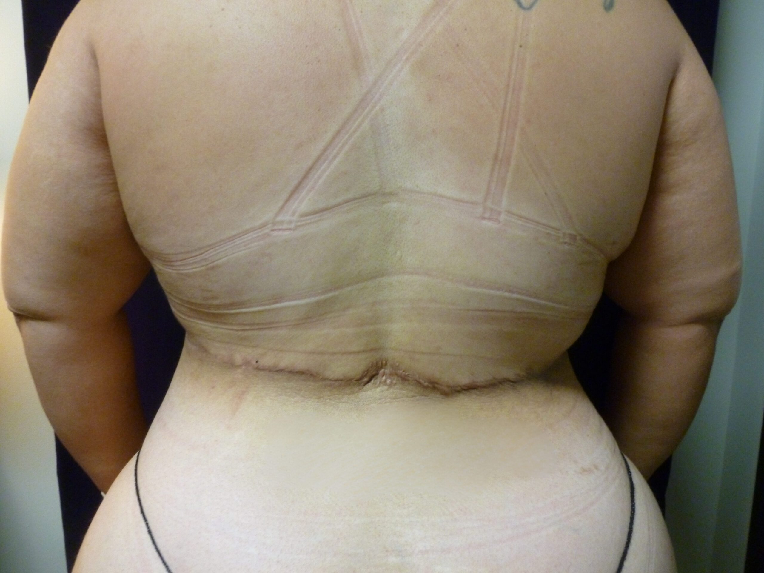 Tummy Tuck Patient Photo - Case 2332 - after view-3