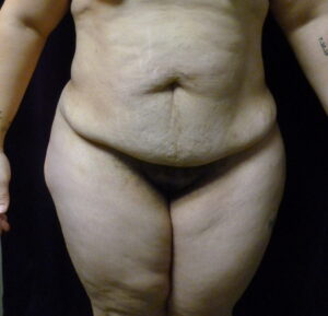 Tummy Tuck - Case 2332 - Before