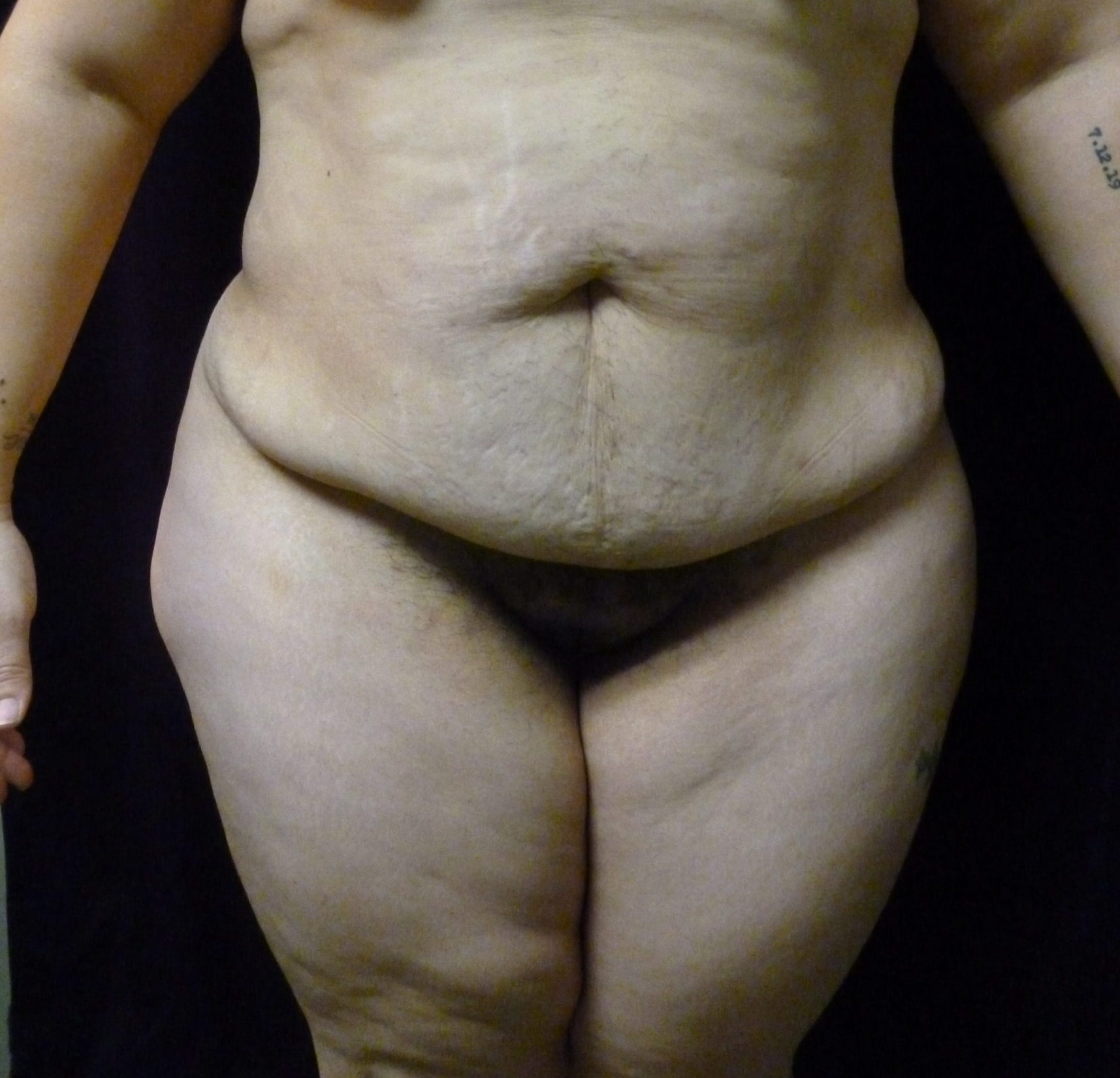 Tummy Tuck Patient Photo - Case 2332 - before view-0