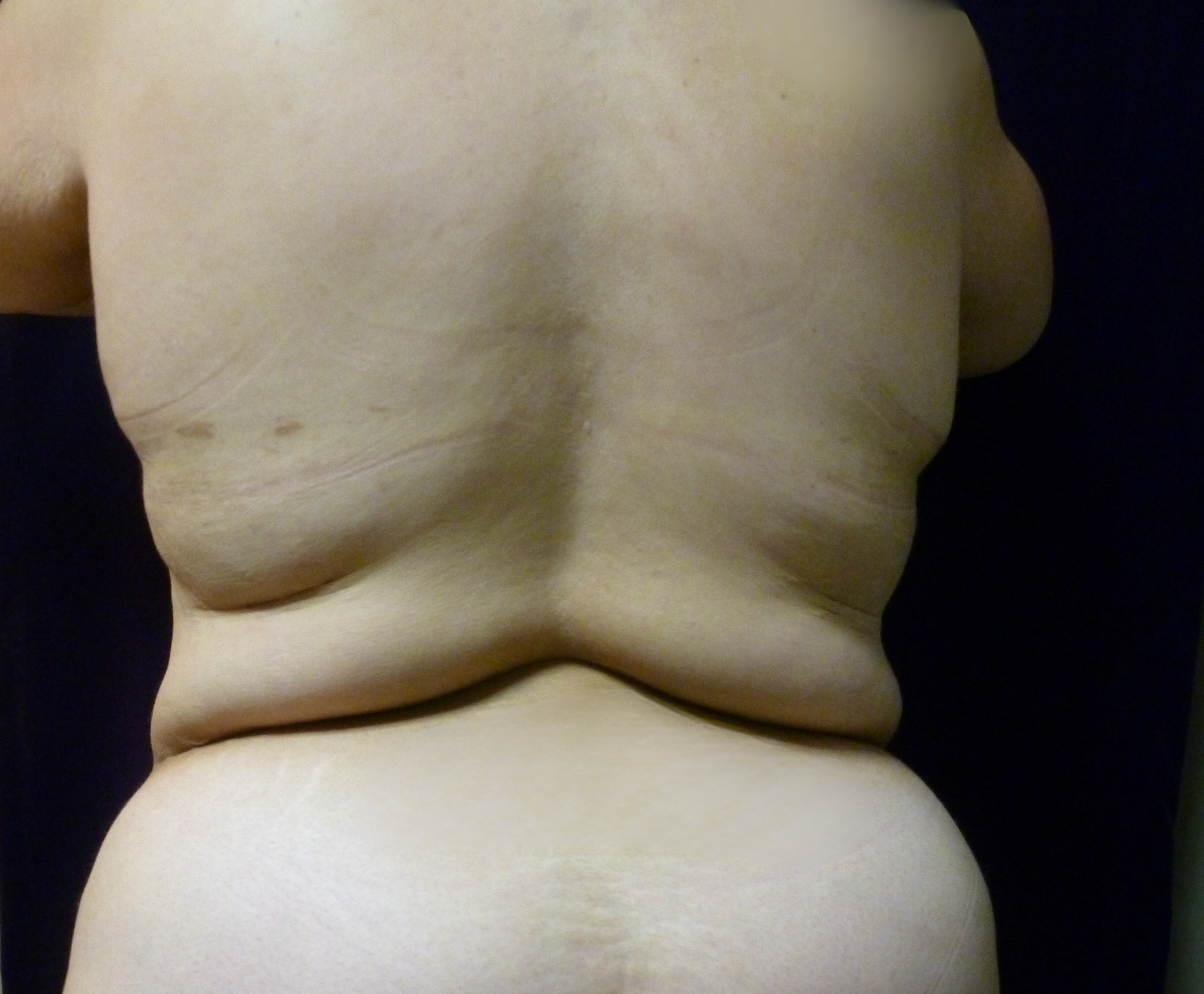 Tummy Tuck Patient Photo - Case 2332 - before view-3