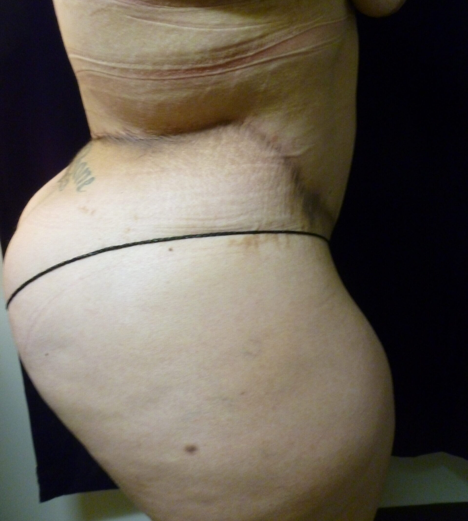 Tummy Tuck Patient Photo - Case 2332 - after view-2