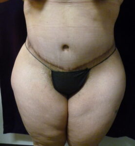 Tummy Tuck - Case 2332 - After