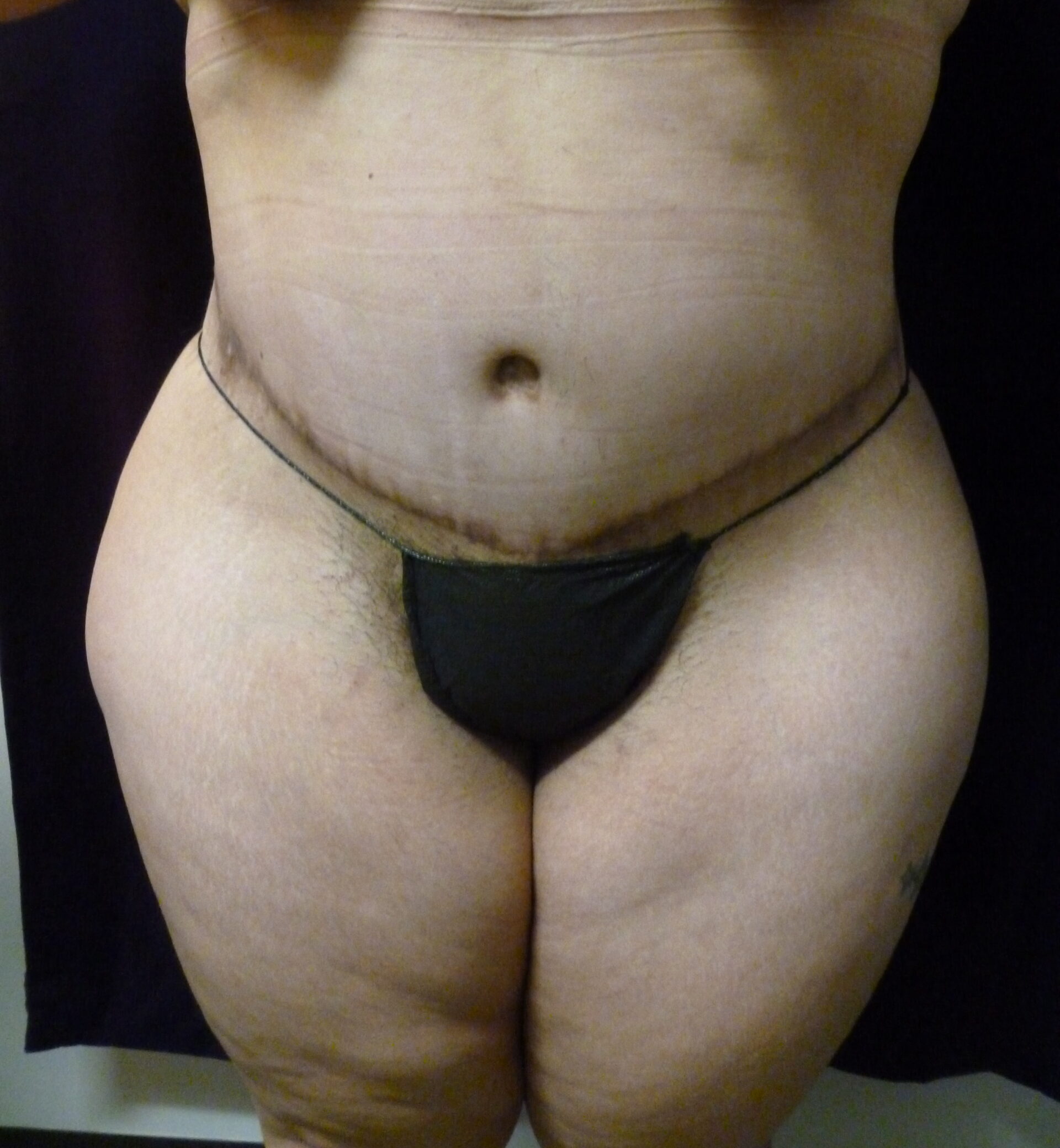 Tummy Tuck Patient Photo - Case 2332 - after view