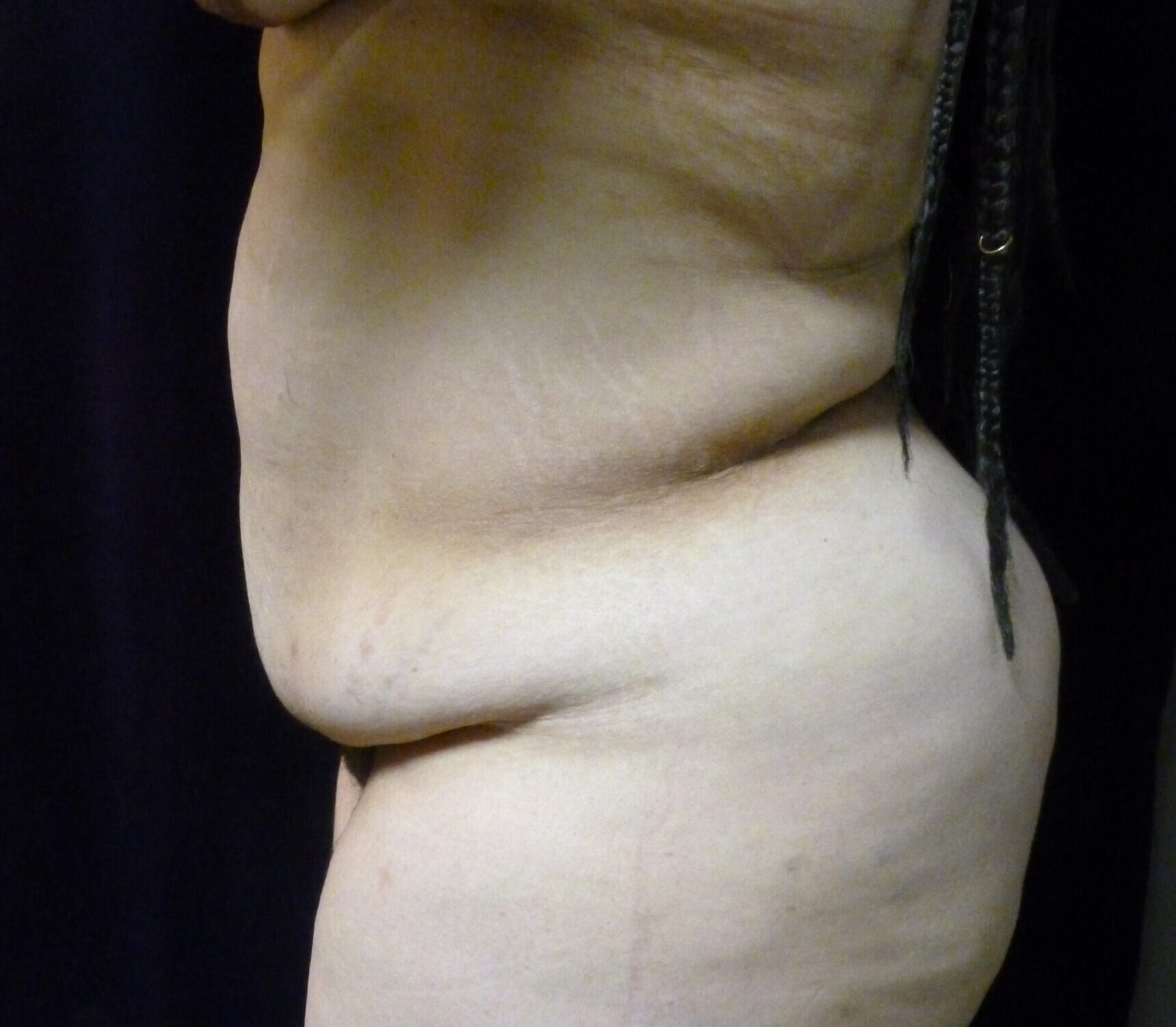 Tummy Tuck Patient Photo - Case 2332 - before view-1
