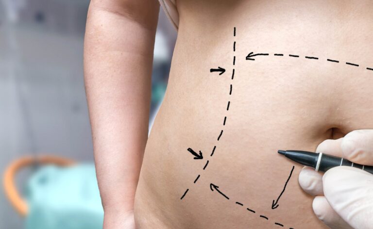 3 Questions to Ask Yourself Before Having a Tummy Tuck 