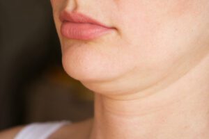 woman with double chin