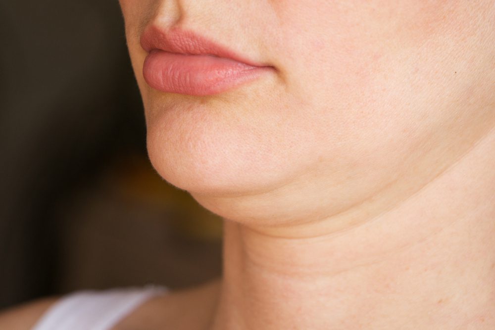 How Chin Lipo Can Help You Say Goodbye to a Double Chin